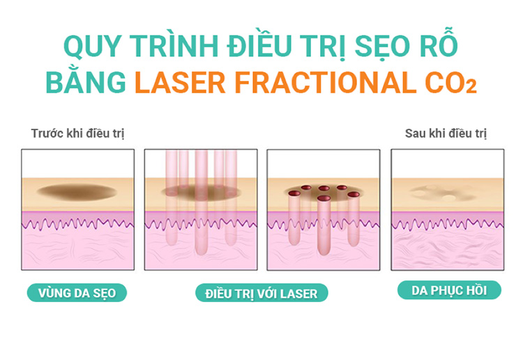 Quy trình điều trị với công nghệ Laser CO2 Fractional